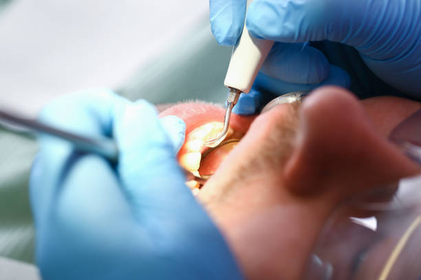 Best Emergency Tooth Extraction in Pierre, SD