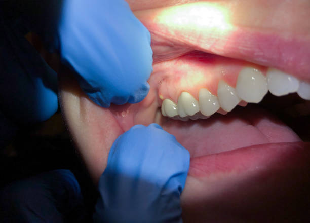 Best Emergency Treatment for Toothache in Pierre, SD